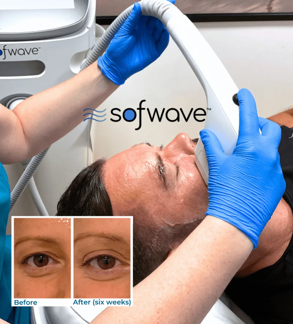 Sofwave Main